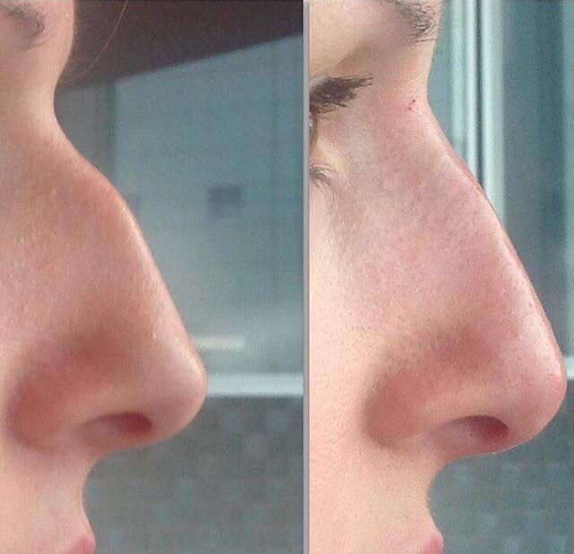 Коррекция носа гиалуроновой кислотой фото до и после