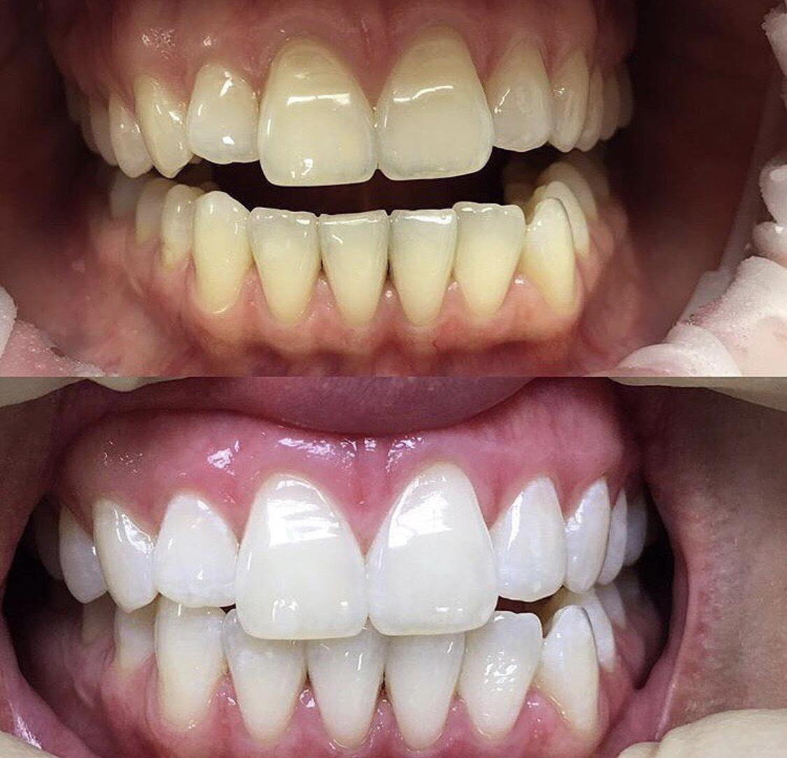 Чеширский кот стоматология реставрация зуба